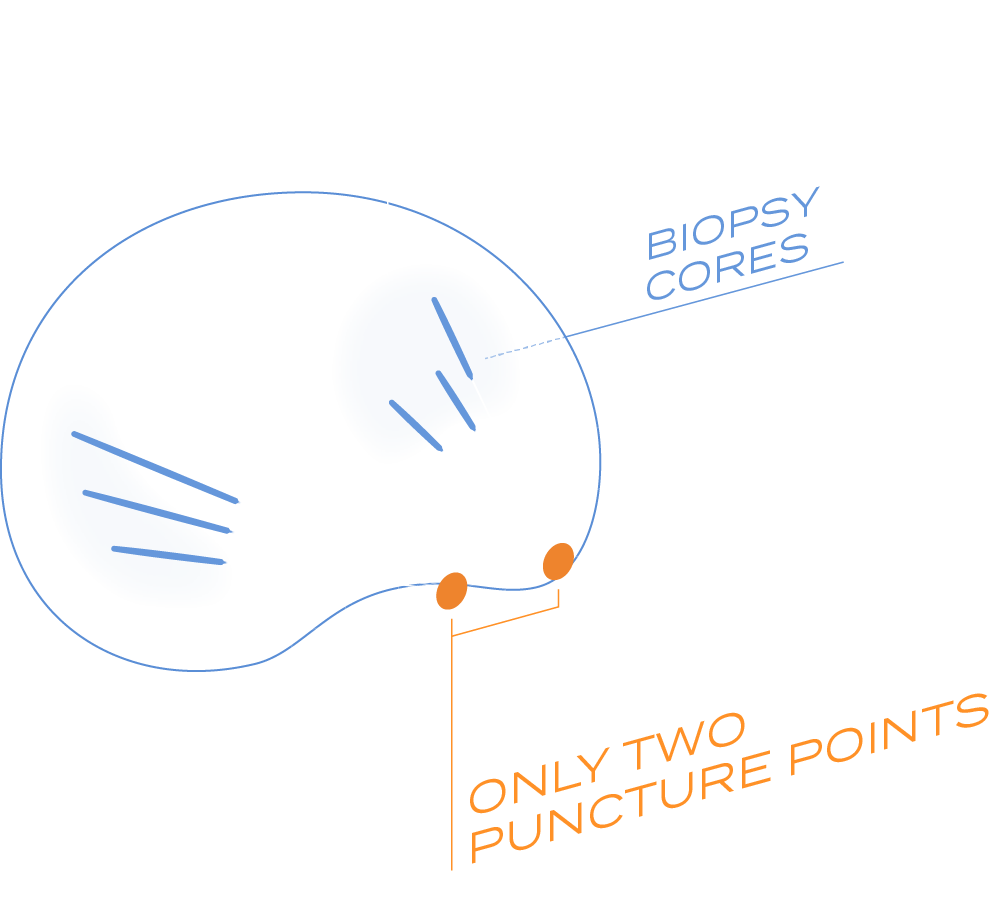 Graphic depicting access points to biopsy cores in a prostate. Rotating the probe allows to access all regions of interest using only two puncture points.
