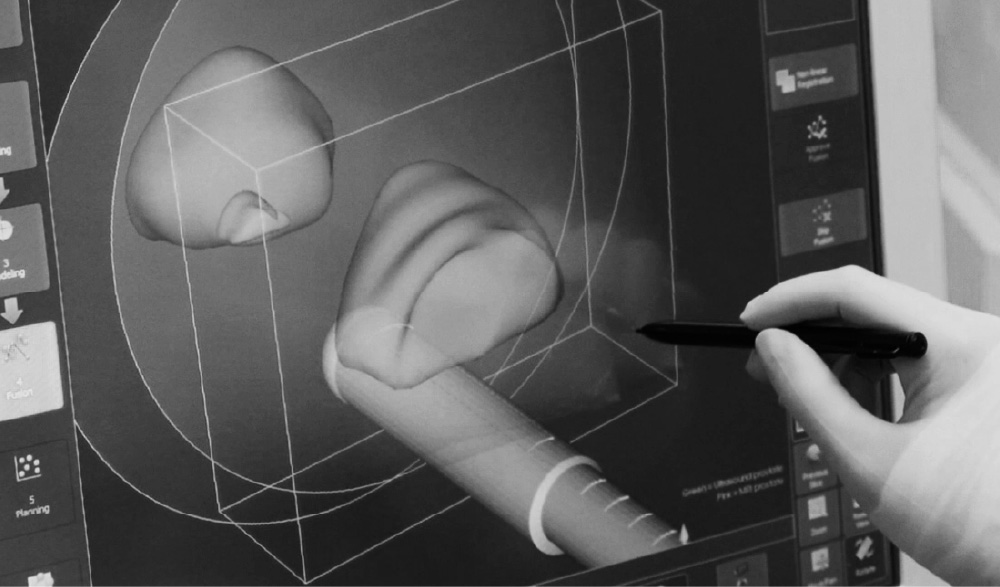 A photo of a surgeon hand using a stylus to rotate a 3D model of a prostate on a Mona Lisa system screen.