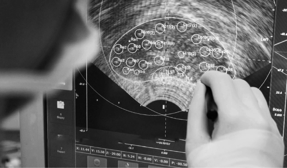 Photo of a surgeon's hand using a stylus to mark regions on an ultrasound view of a prostate.